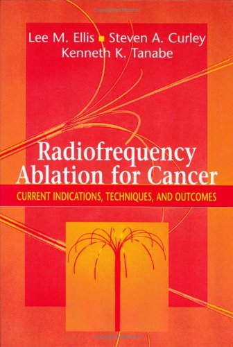 Radiofrequency Ablation For Cancer