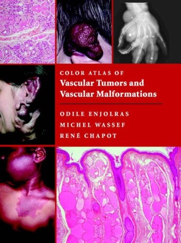 Color Atlas Of Vascular Tumors And Vascular Malformations