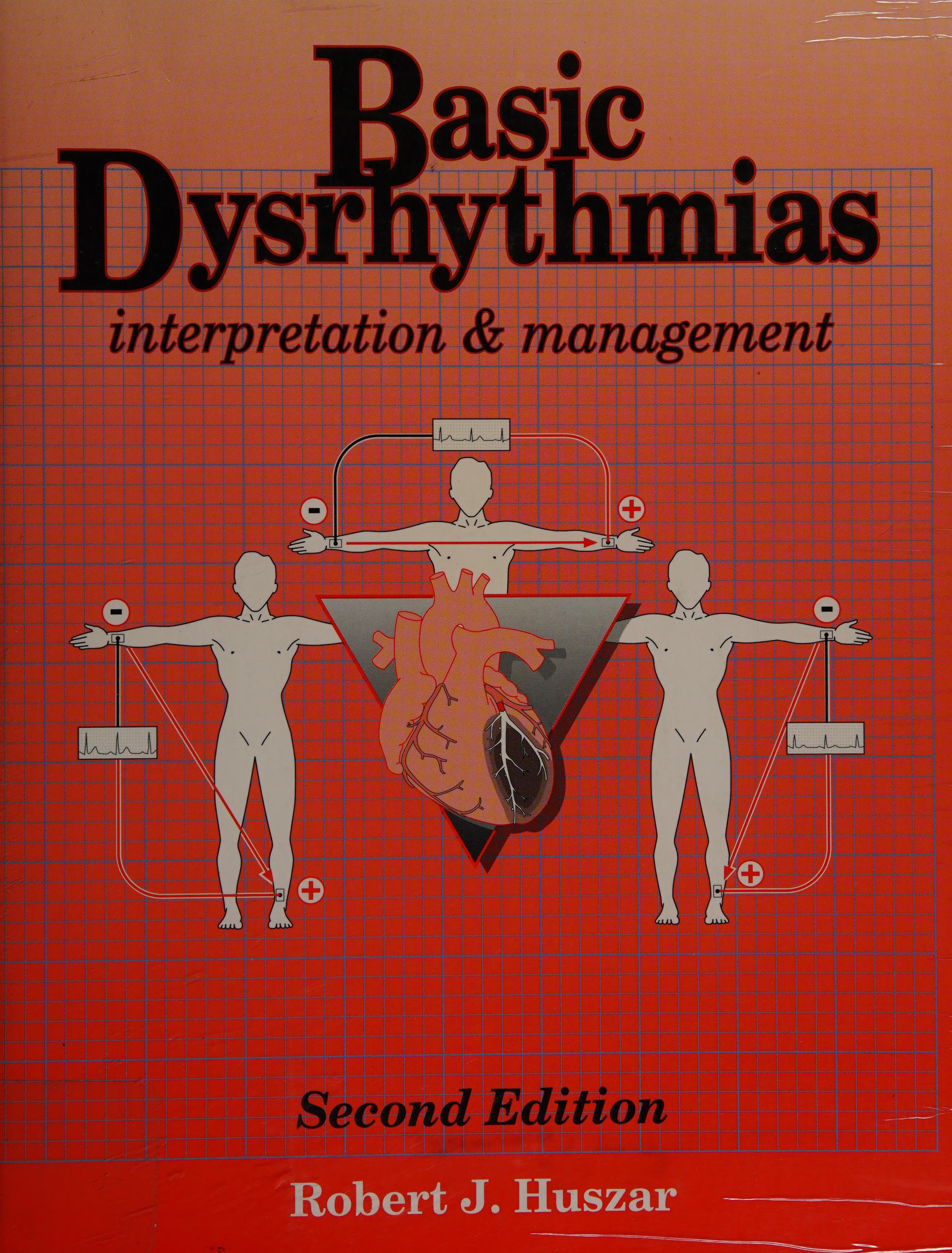 Basic Dysrhythrams Interpretations & Management