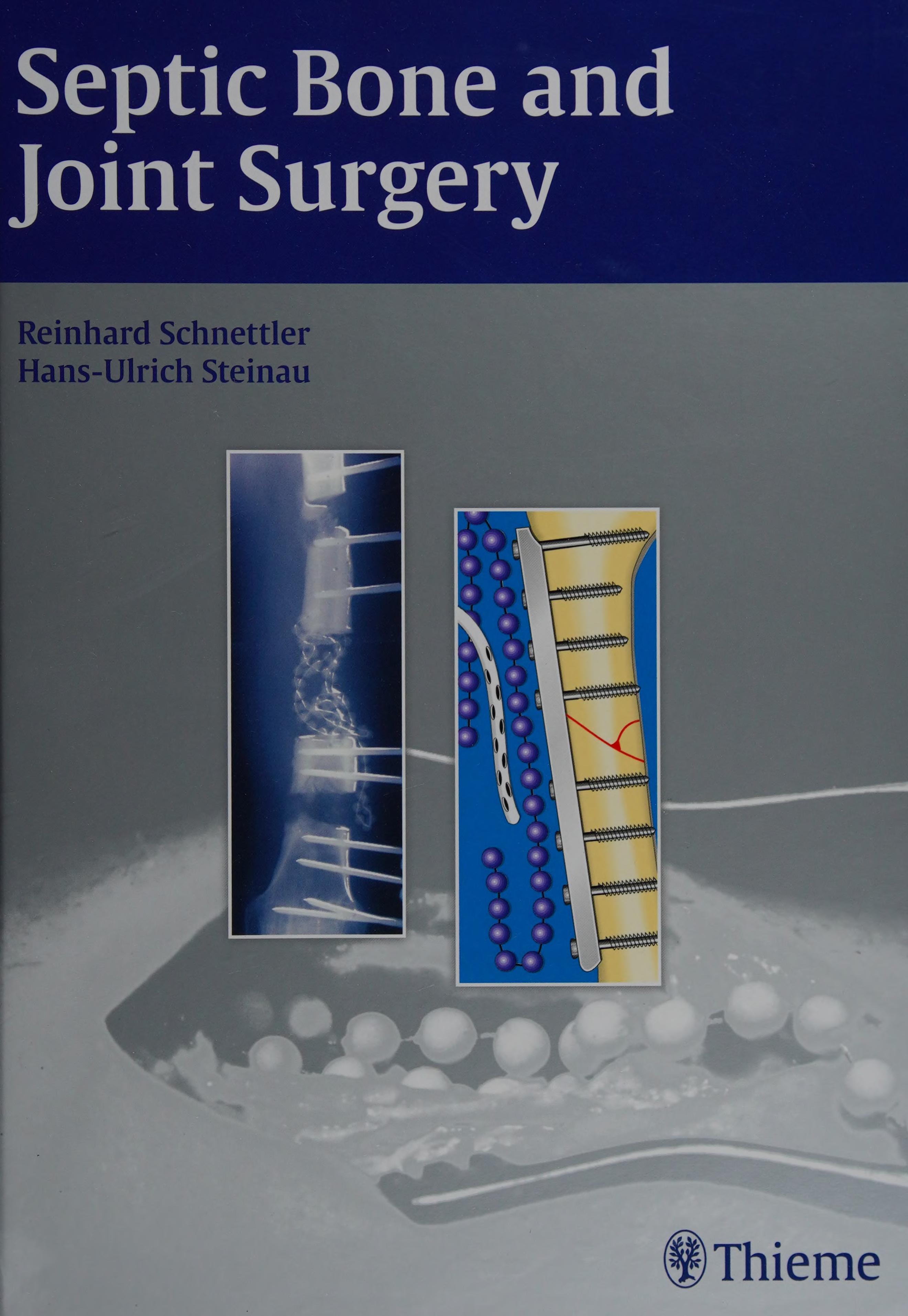 Septic Bone and Joint Surgery