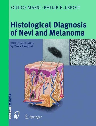 Histological Diagnosis of Nevi and Melanoma